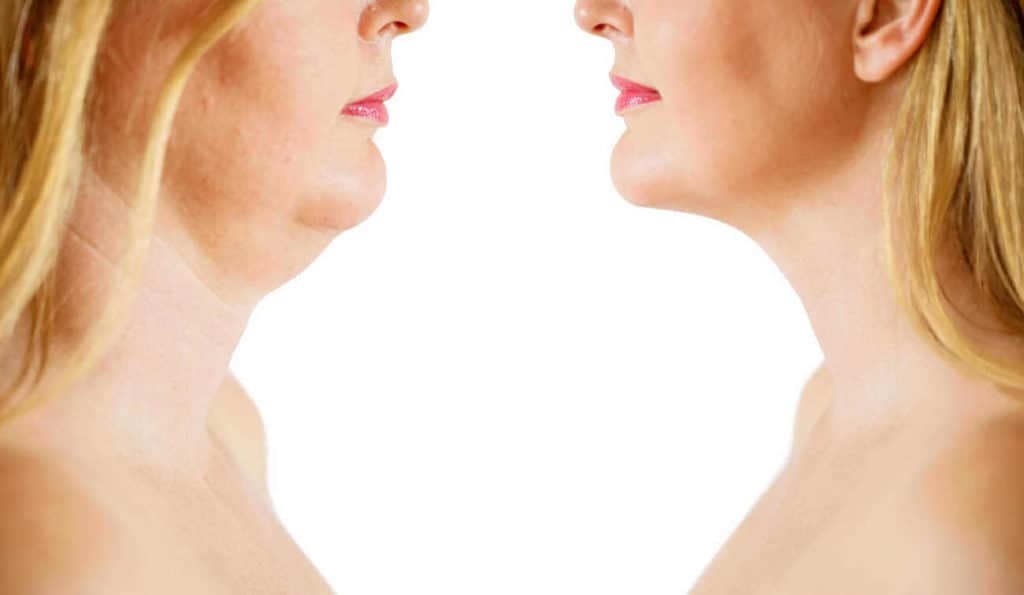 Double Chin treatment Merthyr Tydfil before and after results