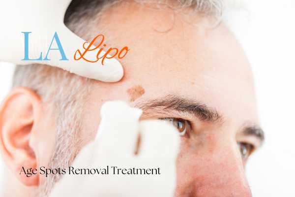 What Are the Most Effective Treatments for Age Spots Merthyr Tydfil?