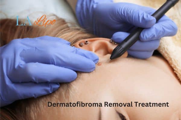 Dermatofibroma Removal Treatment Merthyr Tydfil