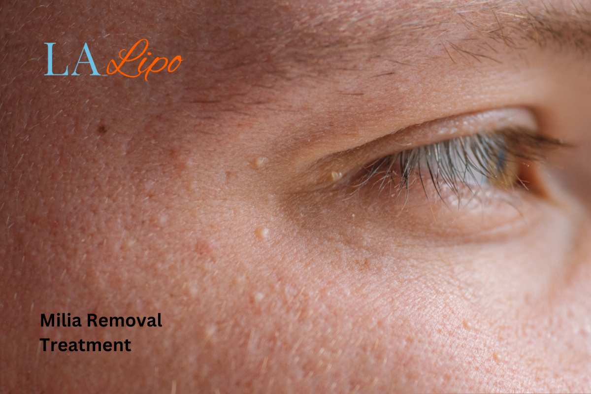 Cryopen Milia Removal: Is It the Easiest and Safest Option Merthyr Tydfil?