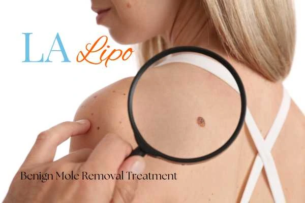 Why getting moles removed Merthyr Tydfil can boost your confidence!