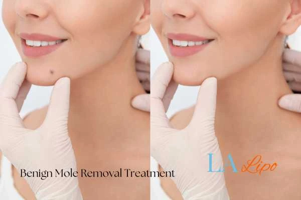 woman's before and after mole removal Merthyr Tydfil results