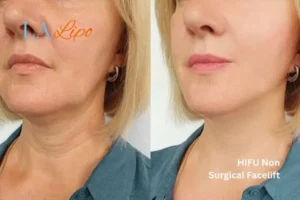 hi-fu for wrinkles Merthyr Tydfil before and after results