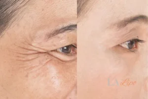 Before and after results of woman - HI-fu wrinkles reduction treatment Merthyr Tydfil