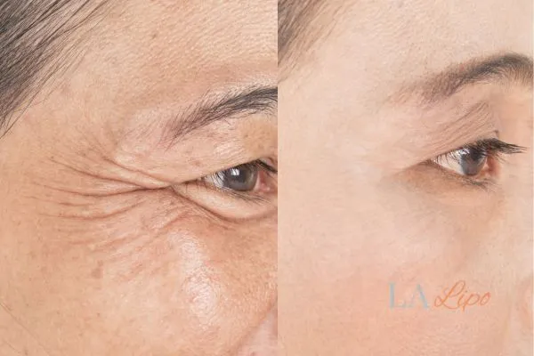 Before and after results of woman - HI-fu wrinkles reduction treatment Merthyr Tydfil