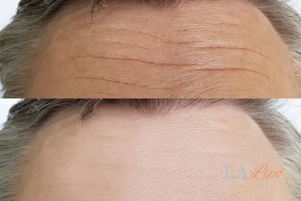 results of HIFU Merthyr Tydfil on mans forehead to help reduce lines and wrinkles