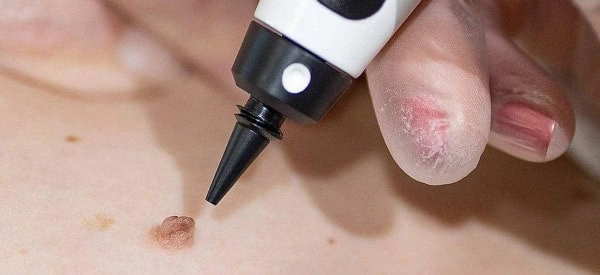 skin tag removal using cryopen Merthyr Tydfil