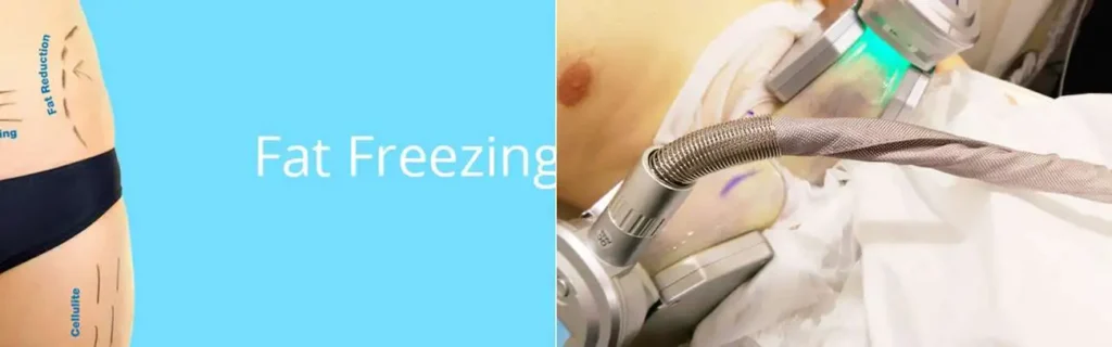 Fat freezing Merthyr Tydfil on multiple areas of the body