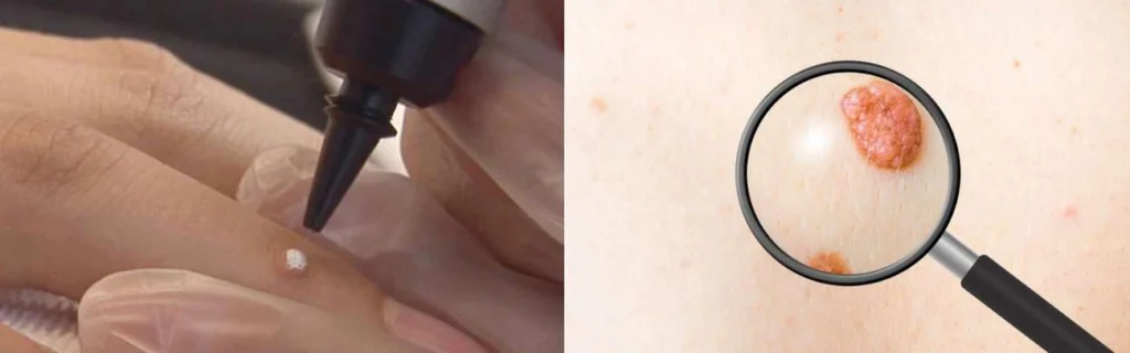 Person getting moles removed with cryopen Merthyr Tydfil