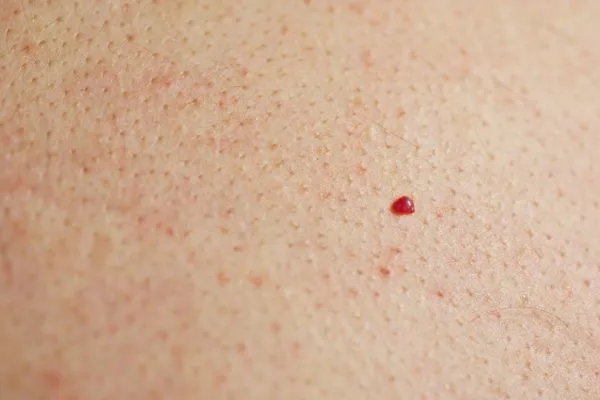 close up of a cherry angioma Merthyr Tydfil
