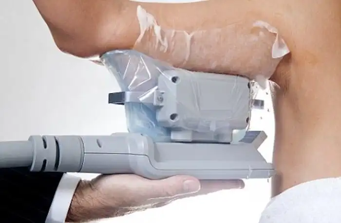 Picture of fat freezing Merthyr Tydfil on the upper arms.
