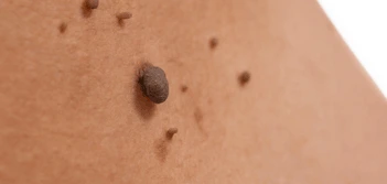image of a skin tag Merthyr Tydfil