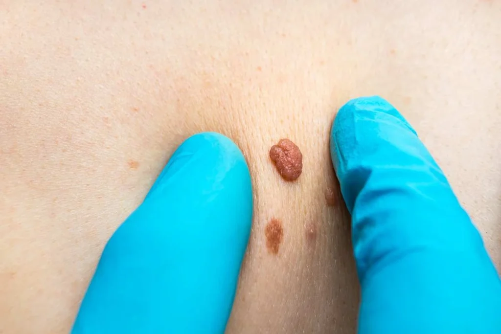 Consultant examining a skin tag Merthyr Tydfil
