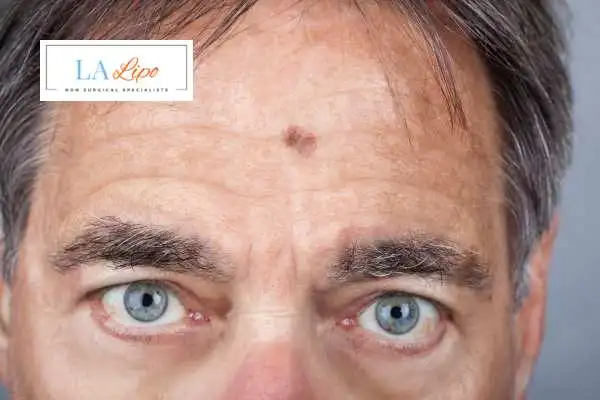 Solar Lentigo Removal Merthyr Tydfil image of man with mark on his forehead