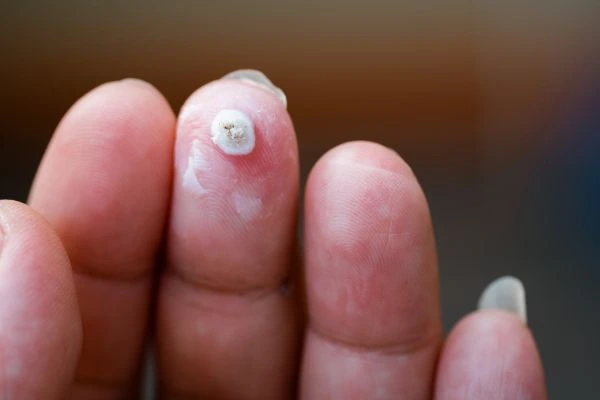 wart on person finger - cryotherapy to treat from LA LIPO Merthyr Tydfil