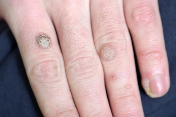 photo of warts on person hand - see wart removal Merthyr Tydfil from LA LIPO