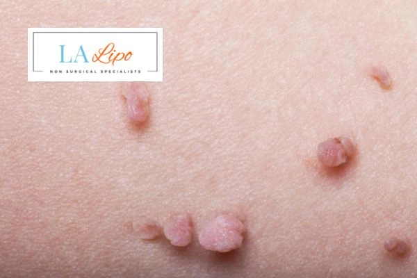 Does cryopen skin tag removal Merthyr Tydfil hurt? Find out now call our team today!