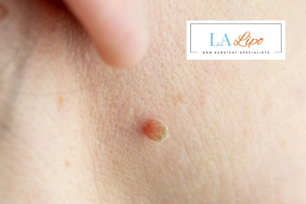 Book skin tag removal Merthyr Tydfil today speak to our team now!