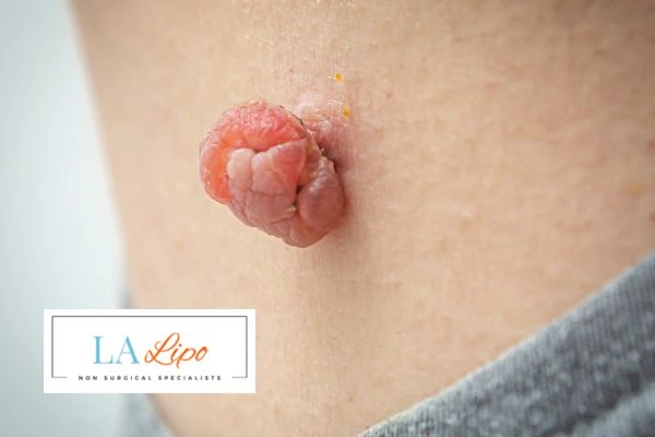 Interested in skin tag removal Merthyr Tydfil? Concerned about the pain? Find out more today!