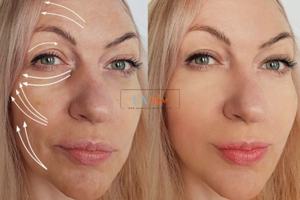 Morpheus 8 results Merthyr Tydfil face lift.