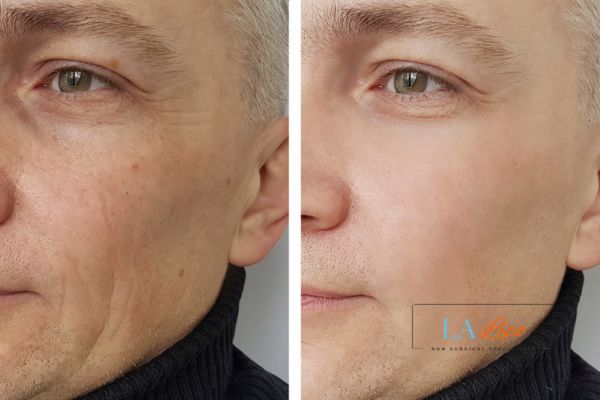 See the amazing results of Morpheus8 Treatment Merthyr Tydfil!