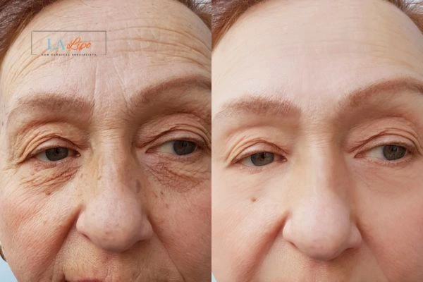 The powerful benefits of Morpheus8 Treatment Merthyr Tydfil - Call Our team today!