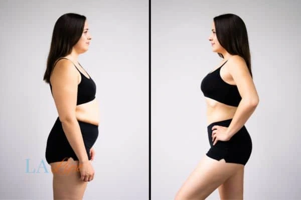 Picture of womans before and after using LA-EMS body sculpting to improve her core strength Merthyr Tydfil