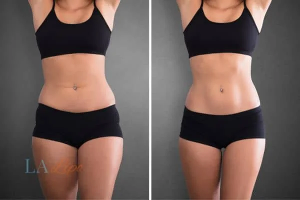 before and after results of non-surgical treatment to help a woman's body image and mental health Merthyr Tydfil