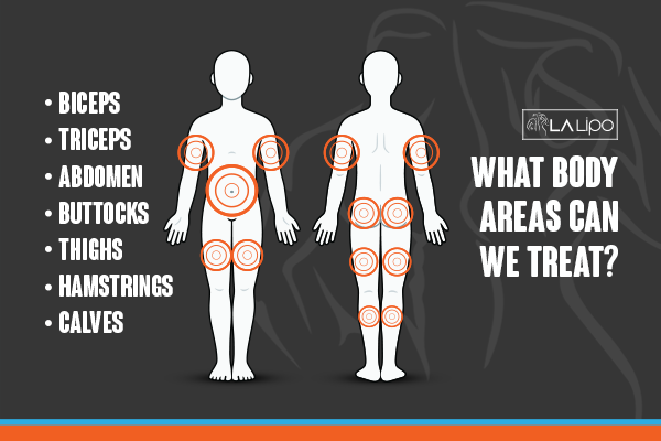 Diagram to show areas you can have LA-EMS Body Sculpting Treatment Merthyr Tydfil