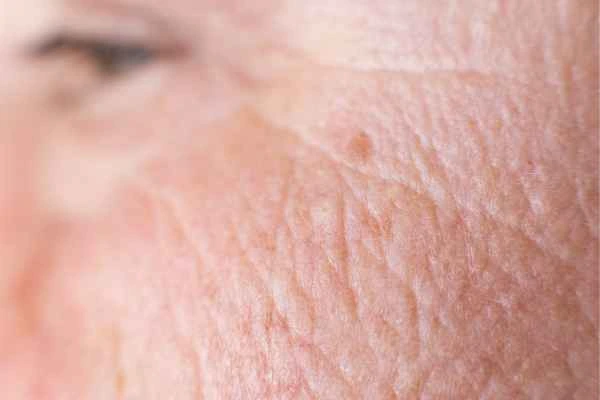 close up picture of a woman's face showing an age spot Merthyr Tydfil