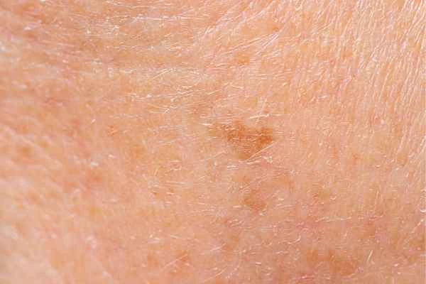 close up picture of age spots Merthyr Tydfil