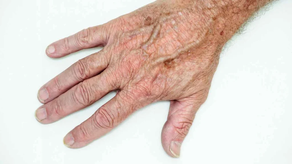 Male hand showing age spot Merthyr Tydfil
