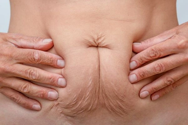 Image of a woman's stomach with loose skin - example of skin tightening Merthyr Tydfil options