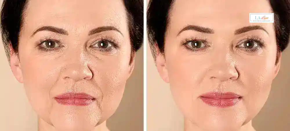 How Long Does It Take to See Results and How Long Do They Last Merthyr Tydfil?