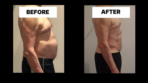 What Symptoms Can Diastasis Recti Cause in Men? Weak Core, Back Pain and Poor Posture Merthyr Tydfil
